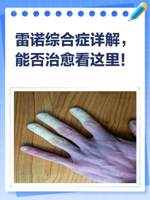 雷诺氏综合症 雷诺氏综合症是什么病